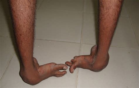 If someone has a club foot , they are born with a badly twisted foot. Talipes. Causes, symptoms, treatment Talipes