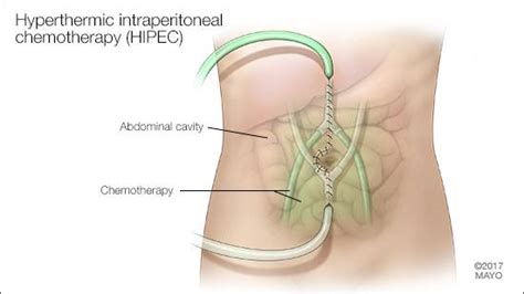 Treatment of recurrent malignant mesothelioma may be one of the following: Peritoneal cancer natural treatment - Cancerul de sange