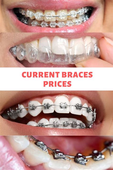 Braces prices in the uk will vary across different regions and from one dentist to another, so it's worth shopping around to get an idea of costs. Current Braces Prices | Appareil dentaire, Orthodontie ...