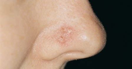 If someone has a lot of tattoos, i will make a special effort to look at that skin and note what i may see. How To Detect Skin Cancer On Nose: Symptoms Of Skin Cancer ...