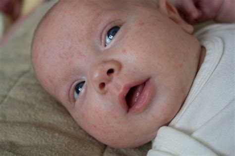 No one wants to be pregnant for 42 weeks. How To Get Rid of Baby Acne: When Baby Doesn't Have Baby ...