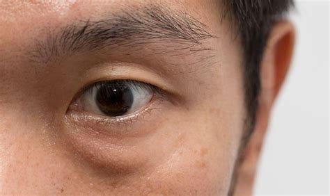 Kedutan mata adalah suatu kondisi ketika kelopak mata (atas atau bawah) atau bahkan alis berdenyut terus menerus. Arti Kedutan Mata Kiri Bawah dari Sisi Medis