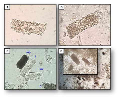 Check spelling or type a new query. Urine Sediment of the Month: Granular & "Muddy Brown ...