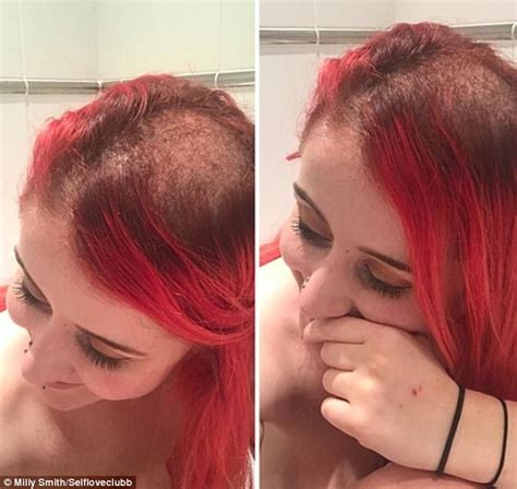 4.2 out of 5 stars 229. Blogger with cervical cancer shares photos of hair loss ...