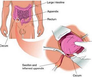 Kesakitan berhampiran pusat atau perut bahagian atas yang menjadi tajam apabila ia bergerak ke bahagian bawah abdomen kanan. M . Zul: Sakit Apendiks/Radang Apendiks Pecah