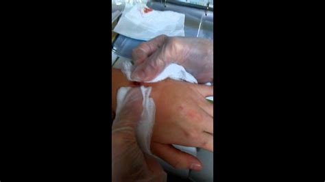 Ingrown hairs are not dangerous, but they can be painful. Ingrown hair infected! - YouTube