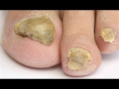 Some people have heard that home remedies. Considering a Laser Treatment For Toenail Fungus? Watch ...