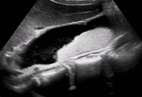 Диета при сладже желчного пузыря