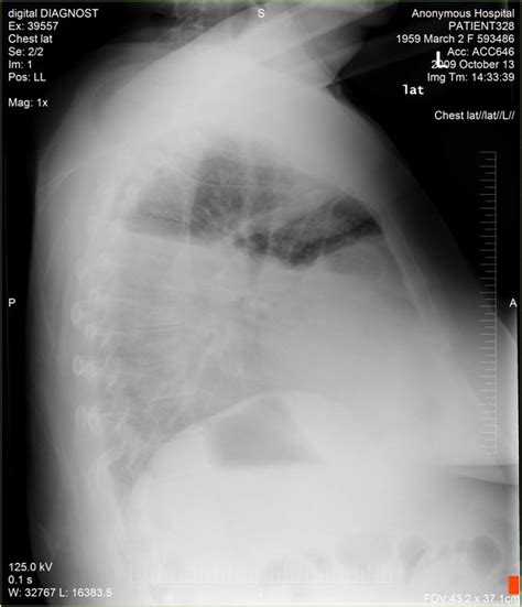 Pneumonia) and loculated effusions from free fluid in the pleural space. Lateral CXR showing right-sided pleural effusion ...