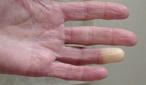 Рейно болезнь диета Болезнь Рейно симптомы у женщин как лечить, народные средства Болезнь Рейно симптомы у женщин как лечить, народные средства Рейно болезнь диета