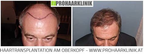 Volleres haar → so funktioniert's! Haartransplantation Vorher Nachher J. Cz. - ProHaarklinik