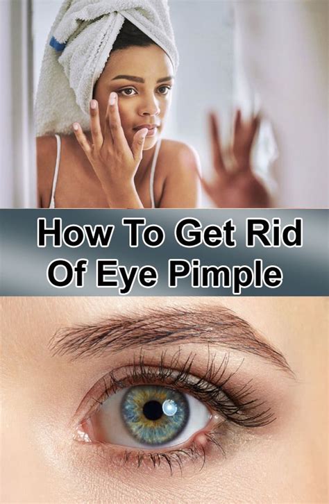 Contact lens acute red eye clare is an inflammation of the outer surface of the eye that occurs only in patients wearing contact lenses. How To Get Rid Of Eye Pimple | Pimples, Eye stye remedies ...