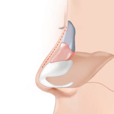 There are many ways to relieve the discomfort that a stuffy nose can bring. Cinderella Plastic Surgery Clinic Korea - Experience a ...