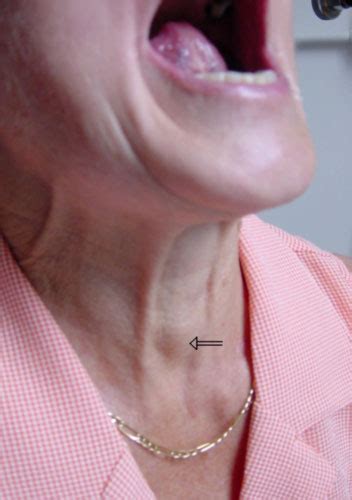 If you feel a lump or a nodule in the area, go see a physician immediately. Causes of Neck Lumps | Total Health
