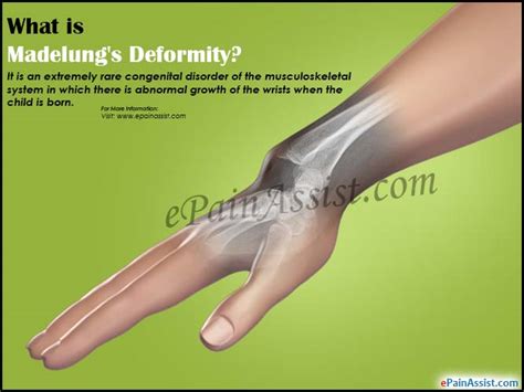 Examination may reveal obvious deformity of the elbow. What is Madelung's Deformity & How is it Treated?