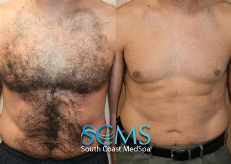 Although you're not 100% guaranteed to last forever it's the best choice if you don't ever want to see your pubic hair again. Laser Hair Removal For Men | Los Angeles | Orange County ...