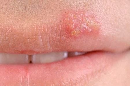 Common signs and symptoms include fever, increased heart rate, increased breathing rate, and confusion. Сепсис (заражение крови): симптомы, первые признаки и ...