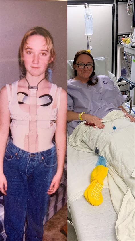 Adults with a history of scoliosis, even those whose conditions were corrected, should understand that the effects of scoliosis can last a lifetime. Back to Where I Started in 2020 | Scoliosis, Scoliosis ...