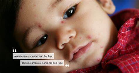 Ia dibawa dan disebarkan melalui gigitan nyamuk. Cara Mengatasi Demam Di Rumah - Dunia Herbal