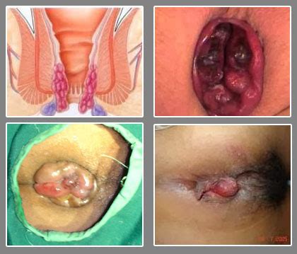 Gambar meme paling hist download now ah yang bener entar boong lagi. Klinik Pengobatan Ambeien: Obat Wasir Resep Dokter di Apotik