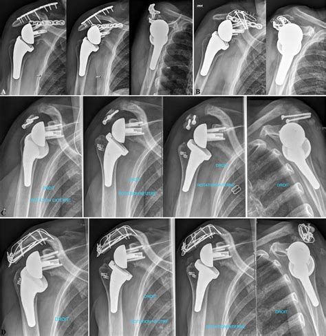 (A-D) Failure of surgical fracture fixation in 2 patients ...