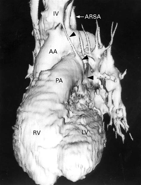 Learn more information about atrial septal defect from the no. Coronary sinus ostial atresia with persistent left ...