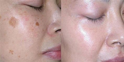 Tak hanya di bawah mata, milia juga bisa tumbuh di sekitar hidung, kelopak mata, dan pipi. LUAR BIASA !!! Cara Herbal Hilangkan Bintik Coklat Di ...