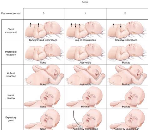 Presence of two or more of the signs of respiratory distress; Grading of neonatal respiratory distress based on the ...