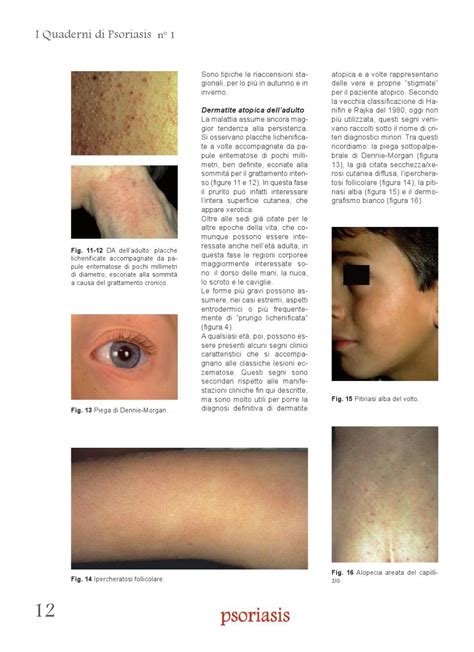 Speciale Ciclosporina - Quaderni Psoriasis n.1 by ...