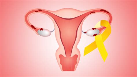 Endometriosis happens when the endometrium, the tissue that usually lines the inside of a woman's uterus, grows outside it. Endometriosis Awareness Month: What you Need to Know About ...