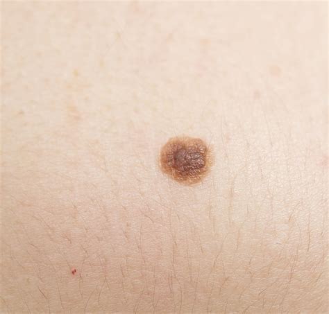 Moles that suggest risk of melanoma include those which are primarily asymmetric, moles with depending on the clinical judgment of the physician, a total surgical excision may be needed to remove the cancerous moles. Key Genetic Factor Controls Mole Development Into Melanoma