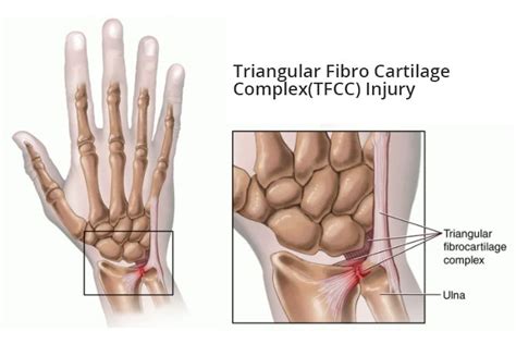 The triangular fibrocartilage complex (tfcc) is formed by the triangular fibrocartilage discus (tfc), the radioulnar ligaments (ruls) and the ulnocarpal ligaments (ucls). Triangular Fibrocartilage Complex (TFCC) Tear