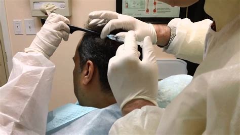 Final cost depends on the type and extent of the hair. AMAZING HAIR LOSS CURE WITH PRP + STEM CELLS IN NEW YORK ...