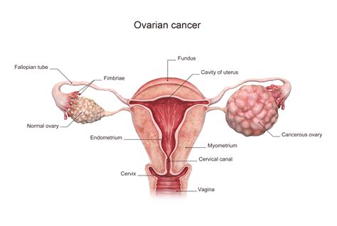 Ovarian Cancer Signs, Symptoms, and Diagnosis | Saint John ...