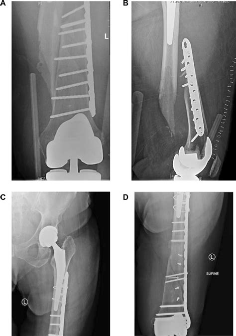Figure 3 from Interprosthetic femoral fractures ...