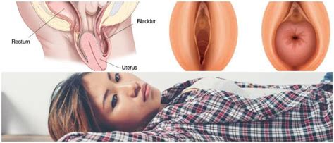 Prolapsed uterus (also known asuterine or pelvic organ prolapse) is when the uterus tumbles down towards the vaginal opening. Uterine Prolapse: Causes, Symptoms and Treatment - Hoool ...