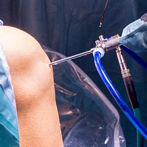Über 7 millionen englischsprachige bücher. Knee Arthroscopy | Assoc Professor Kon Kozak