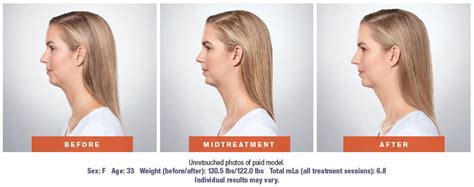 You may have to go back within a couple of. Kybella™ Southampton | Bucks County PA