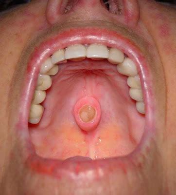 Common signs or symptoms of lip cancer include visible irregularities in the skin on the lower lip. Oral Surgeons: Oral Cancer Pictures