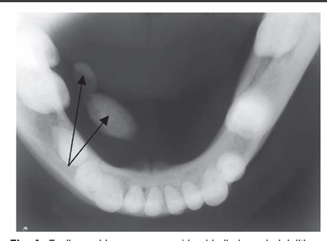 The flow of saliva is obstructed, causing swelling and intense pain. Figure 2 from Management of Submandibular Sialolith using ...