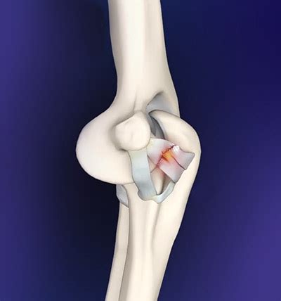 1, 2 trauma and postdislocation injuries are other common causes of collateral ligament injury, which can occur on either side of the joint. Elbow Ligament Reconstruction Surgery Manhattan, Brooklyn NY