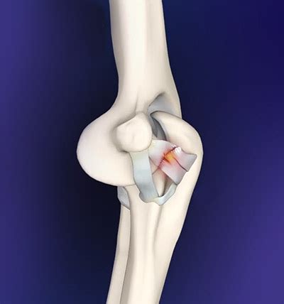 Hold for six seconds, then slowly return to the starting position. Elbow Ligament Reconstruction Surgery Manhattan, Brooklyn NY