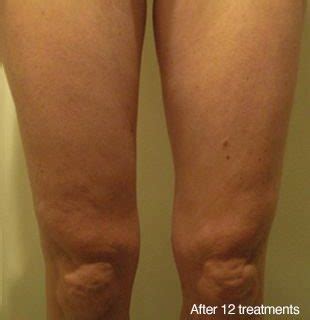 Kells weight loss, you can try red light therapy for skin tightening, skin aging and so much more! Renew & Sculpt Red Light Therapy | Dr. Kells', DC, Weight Loss
