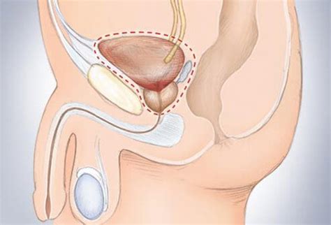 Bladder cancer is the fourth most common cancer in males, but it can also affect females. Bladder Cancer Symptoms, Stages, Treatment