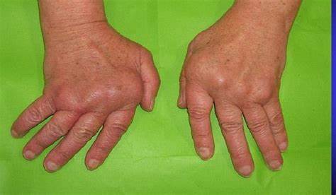 Диета при дискоидной красной волчанки красная волчанка симптомы причины лечение фото | stylequeen.ru красная волчанка симптомы причины лечение фото | stylequeen.ru Диета при дискоидной красной волчанки