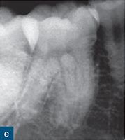 Maybe you would like to learn more about one of these? Apical Periodontitis | Pocket Dentistry