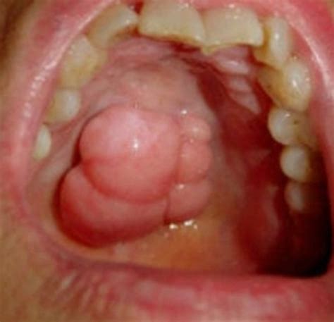 Throat cancer the term head and neck cancer refers to a group of biologically similar cancers originating from the upper aerodigestive tract, including the lip, oral cavity (mouth), nasal cavity to seem; Throat Cancer: Pictures, Survival Rate, Symptoms, Causes ...
