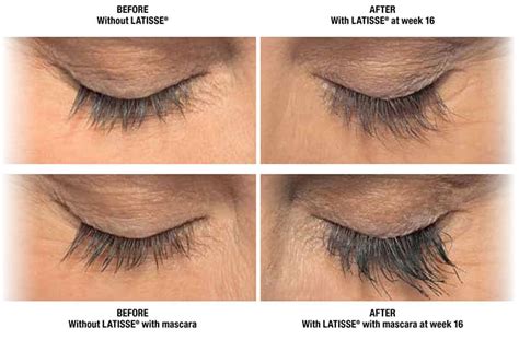 To see how latisse™ can promote eyelash growth over time, feel free to browse through our before and after picture gallery below. Latisse Eyelash Enhancement in Minneapolis - Zel Skin