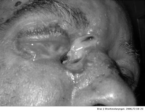 Unilateral vestibulitis in a child—diagnostic of a foreign body in the nasal cavity. Nasal foreign bodies: description of types and ...