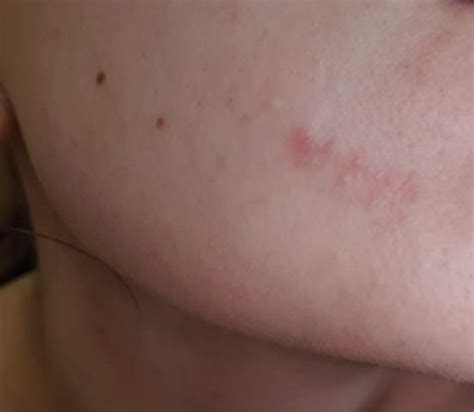 Plötzlicher roter Fleck im Gesicht? (Haut, roter-fleck)